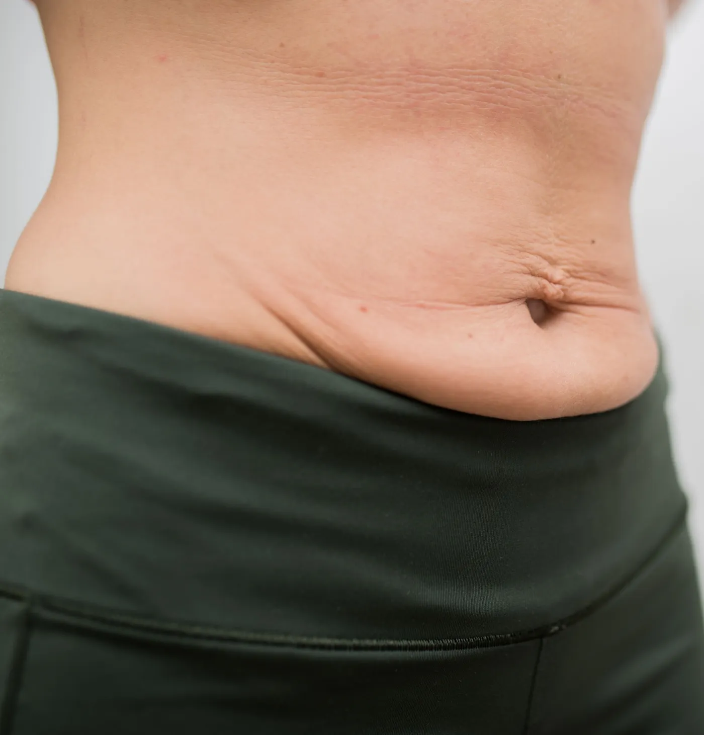 loose skin on belly after rapid weight loss