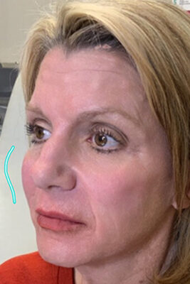 Dermal Fillers - Trueblueasethetics